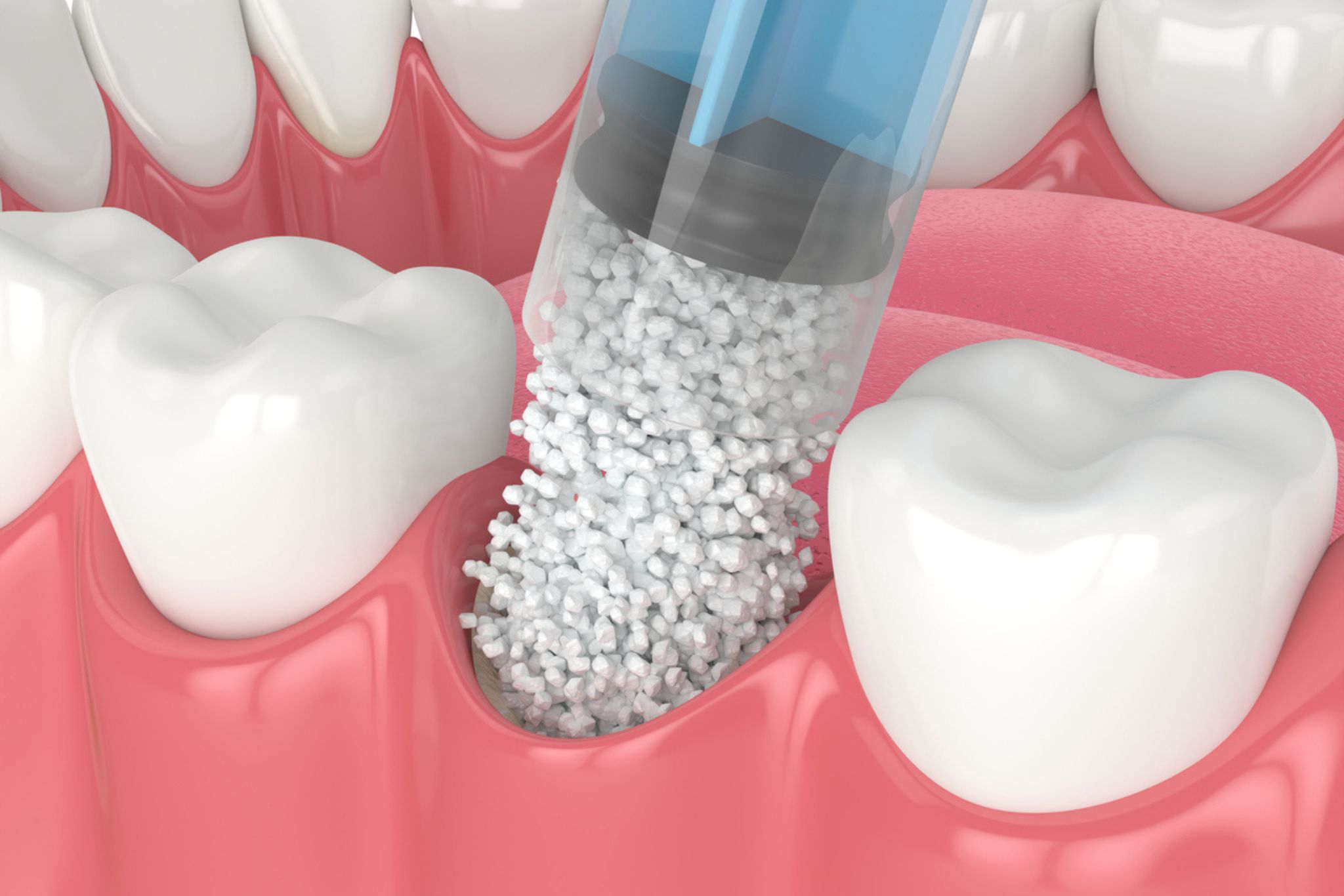 greffe-osseuse-implant-dentaire-marseille