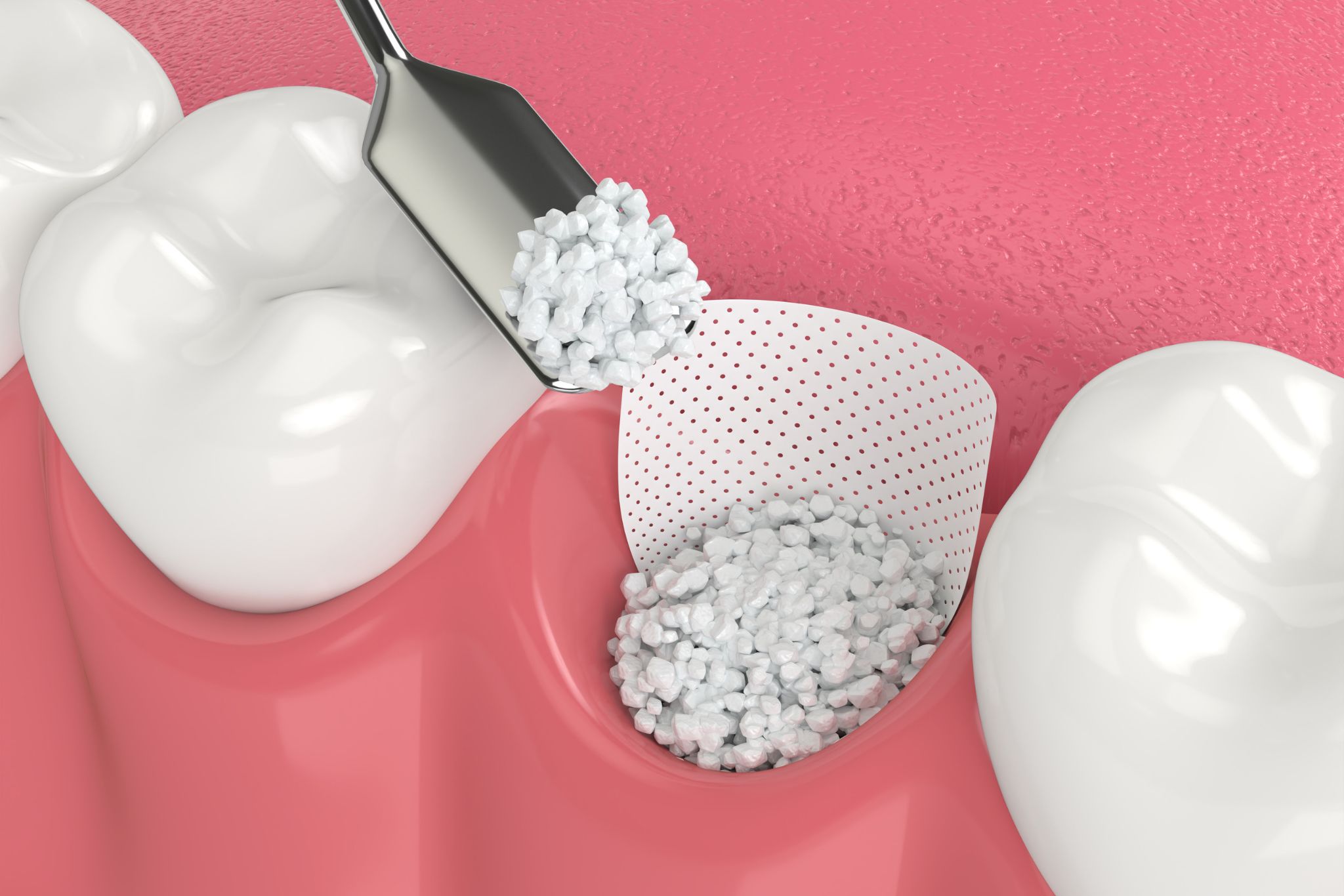 greffe-osseuse-marseille