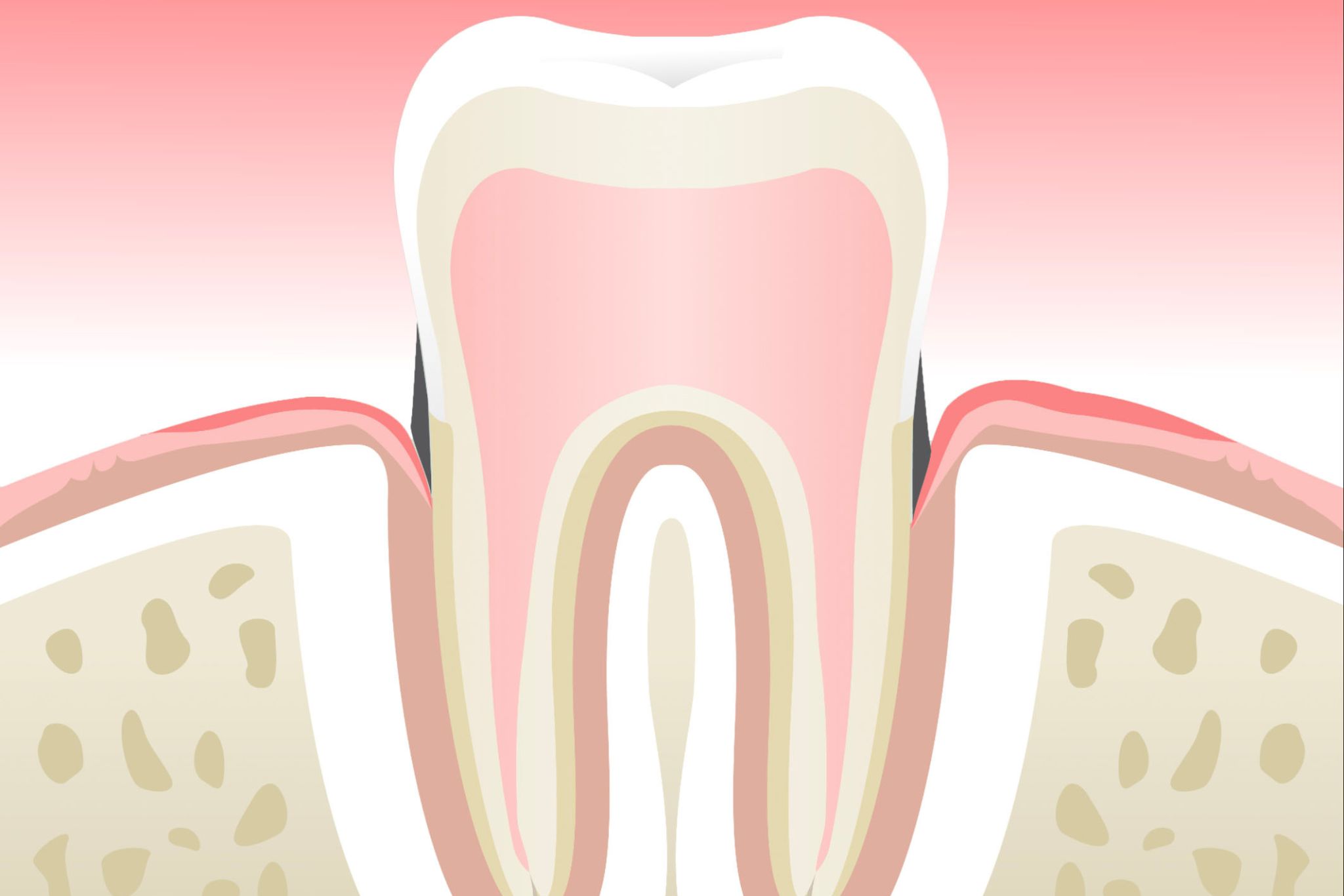 parodontite-stade-2-dentiste-marseille