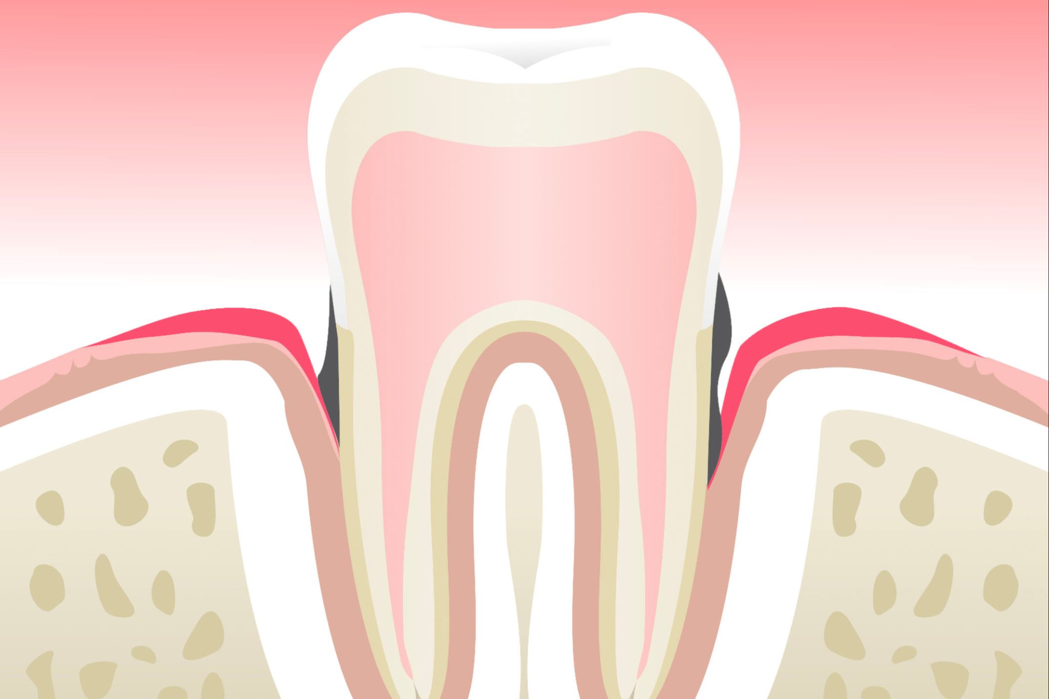 parodontite-stade-3-dentiste-marseille
