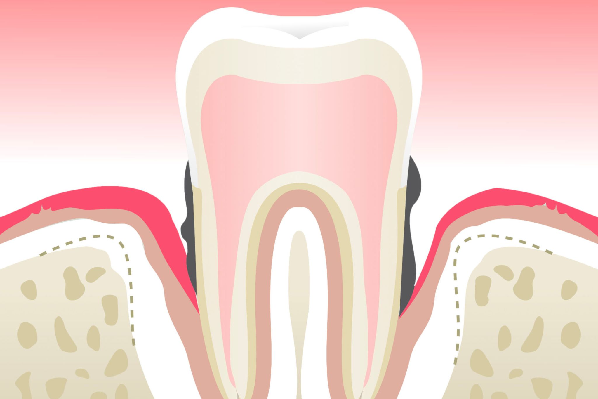 parodontite-stade-4-dentiste-marseille