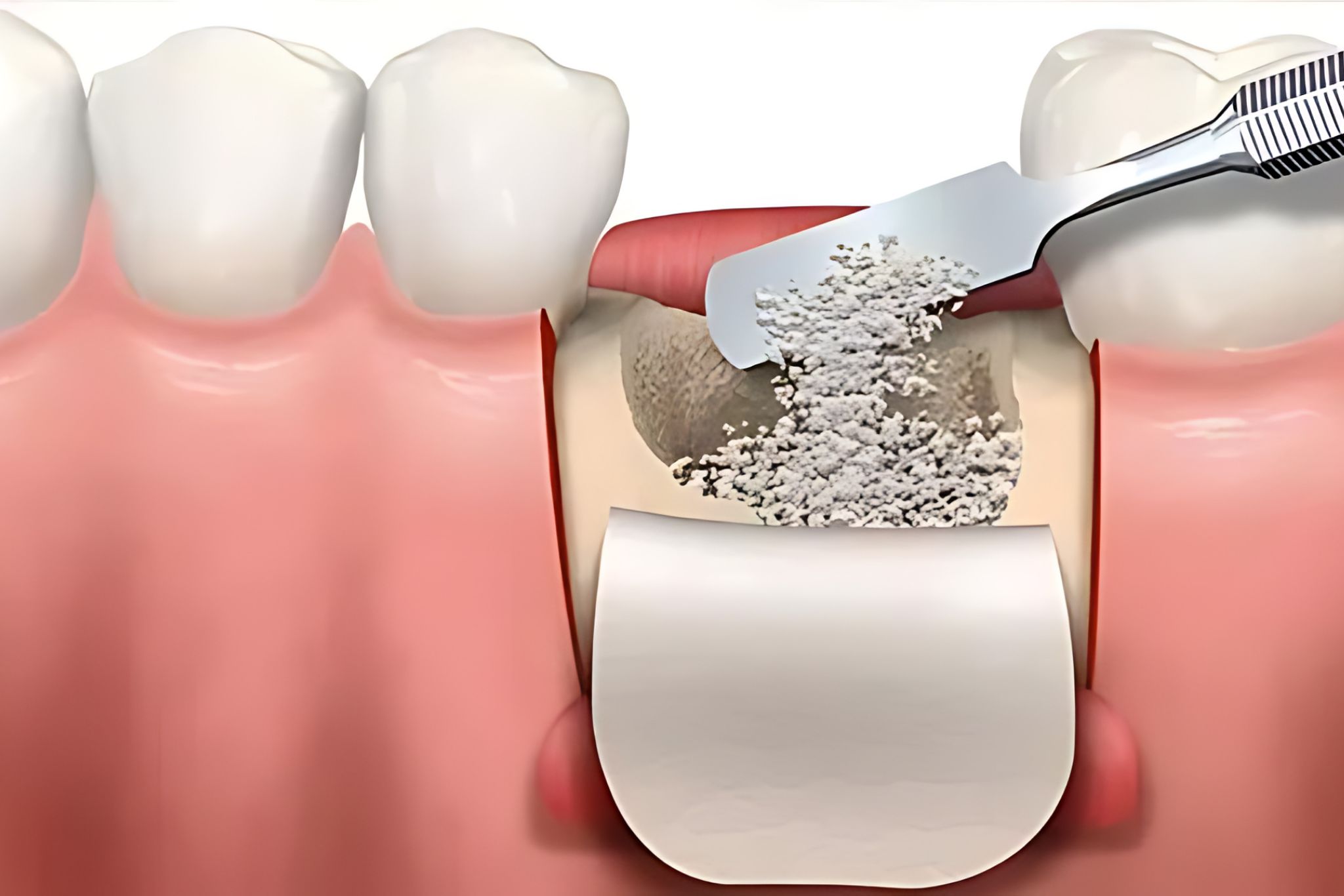 regeneration-osseuse-guidee-marseille