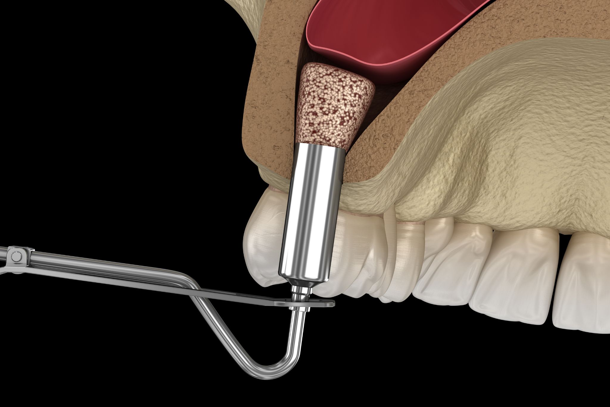 sinus-lift-marseille